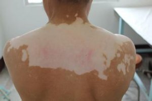什么是散发性白癜风?