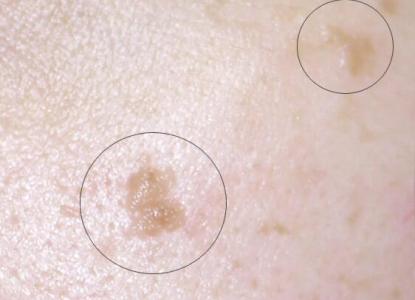 扁平疣在生活中传染性大吗以及如何传染的?