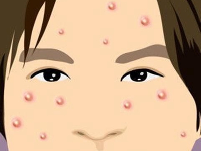 青春痘患者如何做好护理能够减少症状反复呢?