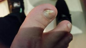 如何判断灰指甲患者?