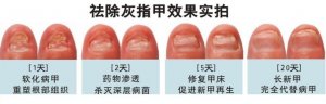 小孩也会患上灰指甲吗