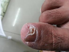 患有灰指甲要不要治?