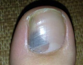生活中灰指甲患者应当如何正确的做好个人护理呢?