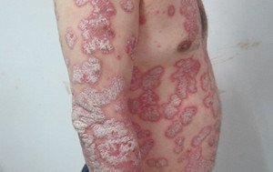 牛皮癣患者治疗方面要注意哪些误区能减少伤害加大呢?