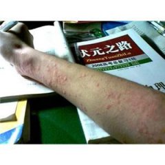 风团荨麻疹图片症状