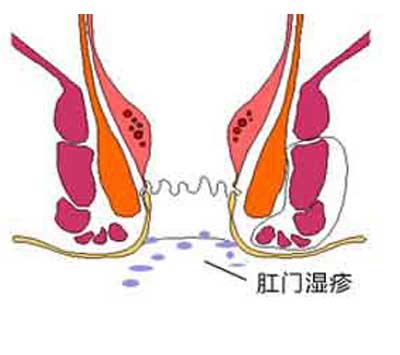 肛门湿疹在临床上都有哪些症状以及如何诊断辨别呢?